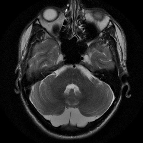 mega cisterna magna headache.